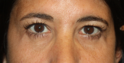 Blepharoplasty Before & After Patient #24882