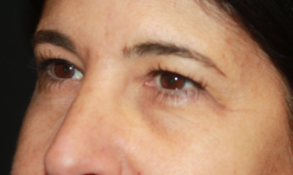 Blepharoplasty Before & After Patient #24882