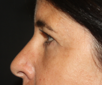 Blepharoplasty Before & After Patient #24882