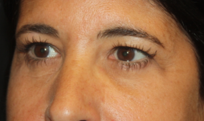 Blepharoplasty Before & After Patient #24882