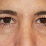 Blepharoplasty Before & After Patient #24882