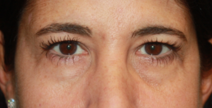 Blepharoplasty Before & After Patient #24882