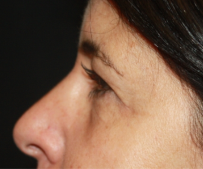 Blepharoplasty Before & After Patient #24882