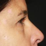 Blepharoplasty Before & After Patient #24882