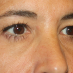 Blepharoplasty Before & After Patient #24882