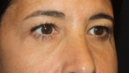 Blepharoplasty Before & After Patient #24882