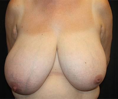 Breast Reduction Before & After Patient #23611