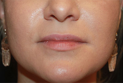 Injectable Fillers Before & After Patient #23257