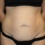 Tummy Tuck Before & After Patient #19896