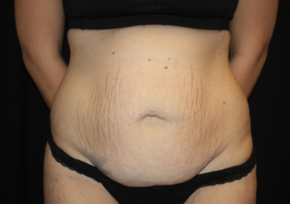 Tummy Tuck Before & After Patient #19896