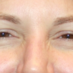 Botox and Dysport Before & After Patient #24686