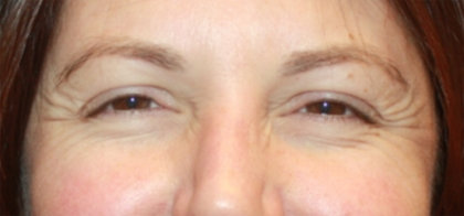 Botox and Dysport Before & After Patient #24686