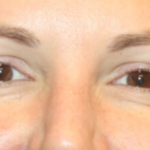 Botox and Dysport Before & After Patient #24686