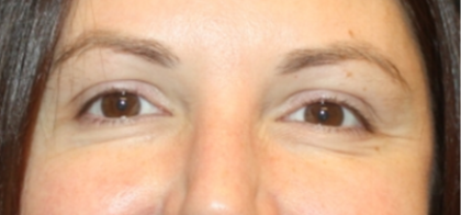 Botox and Dysport Before & After Patient #24686