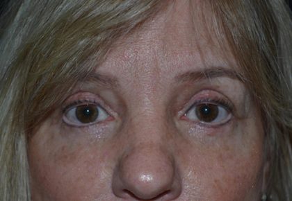 Blepharoplasty Before & After Patient #20131