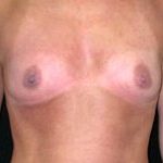 Breast Augmentation - Saline Implants Before & After Patient #20579