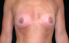 Breast Augmentation - Saline Implants Before & After Patient #20579