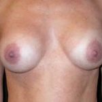 Breast Augmentation - Saline Implants Before & After Patient #20579