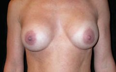 Breast Augmentation - Saline Implants Before & After Patient #20579
