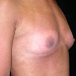 Breast Augmentation - Saline Implants Before & After Patient #20579