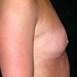 Breast Augmentation - Saline Implants Before & After Patient #20579