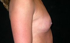 Breast Augmentation - Saline Implants Before & After Patient #20579