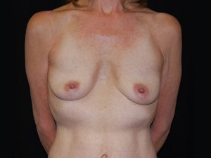 Breast Augmentation - Saline Implants Before & After Patient #20578