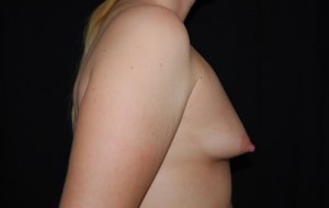 Breast Augmentation - Saline Implants Before & After Patient #20596