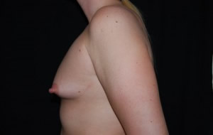 Breast Augmentation - Saline Implants Before & After Patient #20596