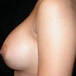 Breast Augmentation - Saline Implants Before & After Patient #20597