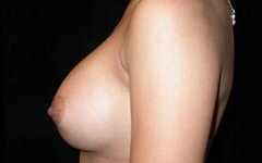Breast Augmentation - Saline Implants Before & After Patient #20597