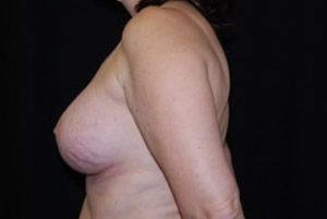 Breast Augmentation - Saline Implants Before & After Patient #20612