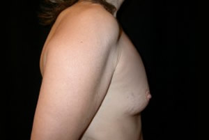 Breast Augmentation - Saline Implants Before & After Patient #20612