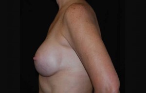 Breast Augmentation - Saline Implants Before & After Patient #20613