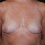 Breast Augmentation - Saline Implants Before & After Patient #20613