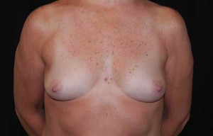 Breast Augmentation - Saline Implants Before & After Patient #20613