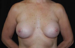 Breast Augmentation - Saline Implants Before & After Patient #20613