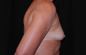 Breast Augmentation - Saline Implants Before & After Patient #20613