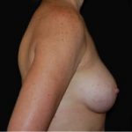 Breast Augmentation - Saline Implants Before & After Patient #20613