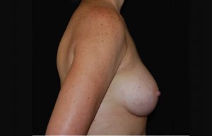 Breast Augmentation - Saline Implants Before & After Patient #20613