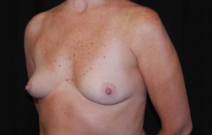 Breast Augmentation - Saline Implants Before & After Patient #20613