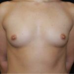 Breast Augmentation - Saline Implants Before & After Patient #20634