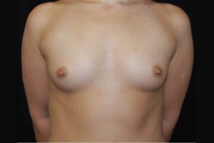 Breast Augmentation - Saline Implants Before & After Patient #20634