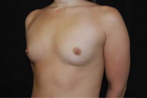 Breast Augmentation - Saline Implants Before & After Patient #20634