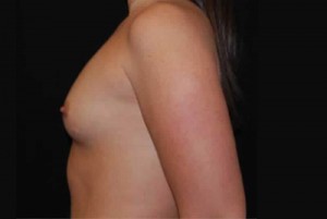 Breast Augmentation - Saline Implants Before & After Patient #20634