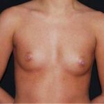 Breast Augmentation - Saline Implants Before & After Patient #20635