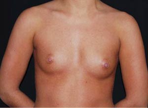 Breast Augmentation - Saline Implants Before & After Patient #20635