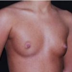 Breast Augmentation - Saline Implants Before & After Patient #20635