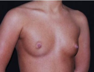 Breast Augmentation - Saline Implants Before & After Patient #20635