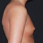 Breast Augmentation - Saline Implants Before & After Patient #20635